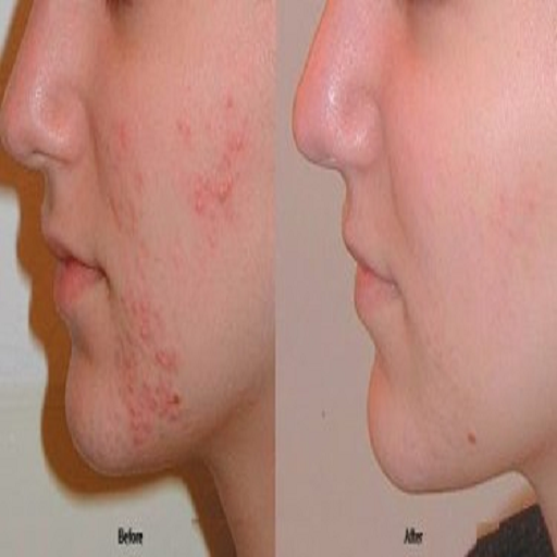 Natural Ways to Remove Pimples icon