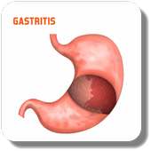 Treat Gastritis on 9Apps