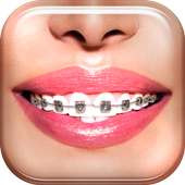 Braces on 9Apps