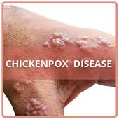 Chickenpox Disease on 9Apps