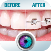 Before and After braces Photo icon