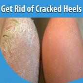 Get Rid of Cracked Heels on 9Apps