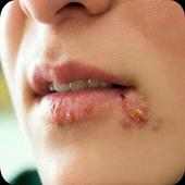 Home Remedies for Herpes